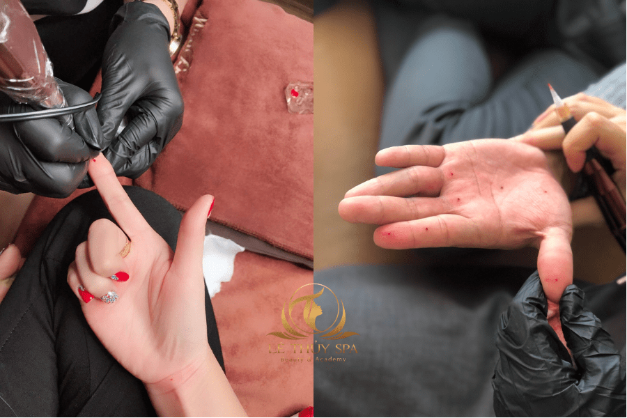 nốt ruồi son đầu ngón tay trỏ