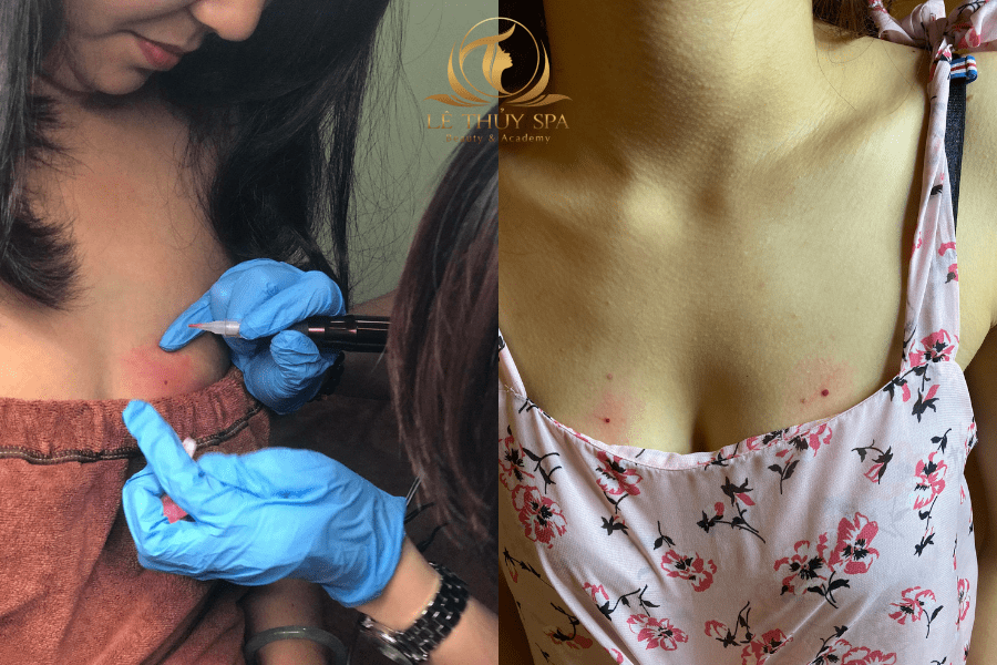 Nốt ruồi son trên ngực
