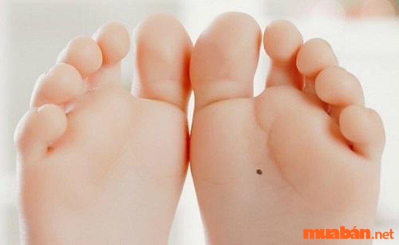 nốt ruồi bàn chân