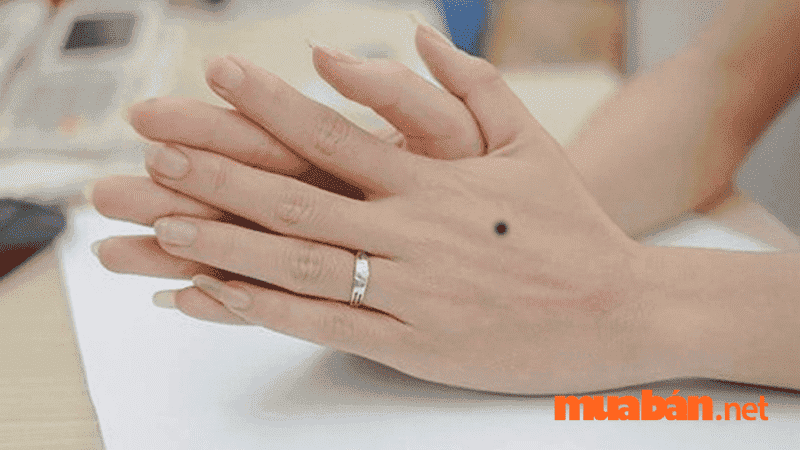 nốt ruồi cổ tay