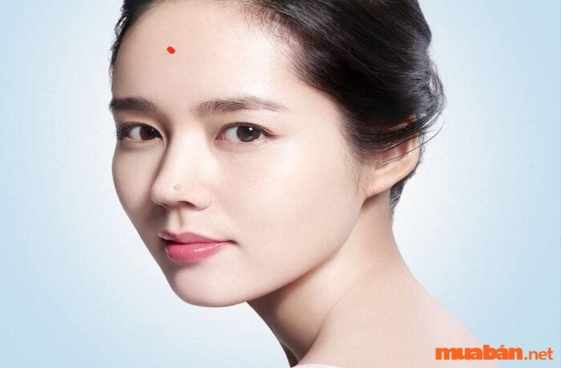 Nốt ruồi ở trán