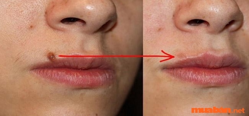 Nốt ruồi ở trán