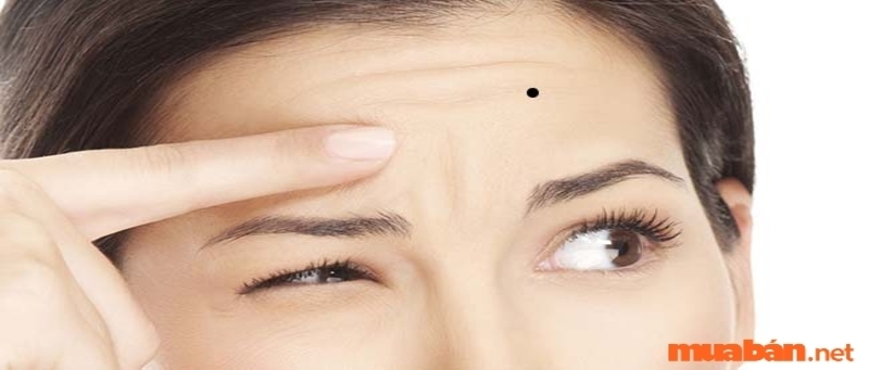 Nốt ruồi ở trán