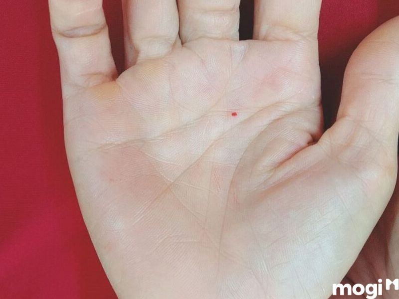 Có nên xoá nốt ruồi trong lòng bàn tay hay không?