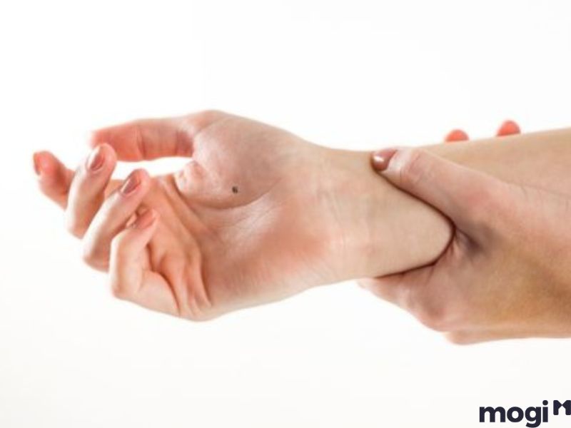 Nốt ruồi hình thành như thế nào