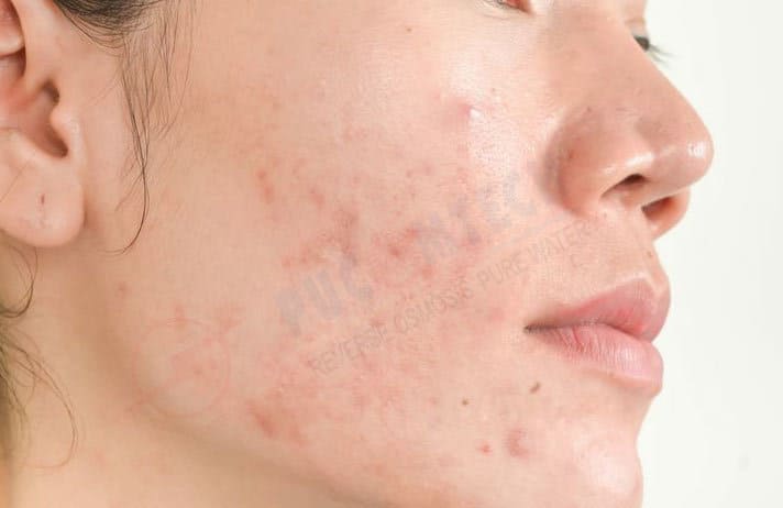 Trị mụn hiệu quả với nước đậu đen