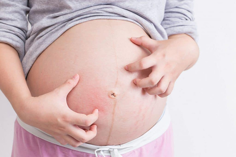 Triệu chứng viêm nang lông ngứa khi mang thai
