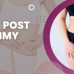 5-Week Post-Op Tummy Tuck