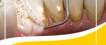 How To Remove Tartar From Teeth Without Dentist?