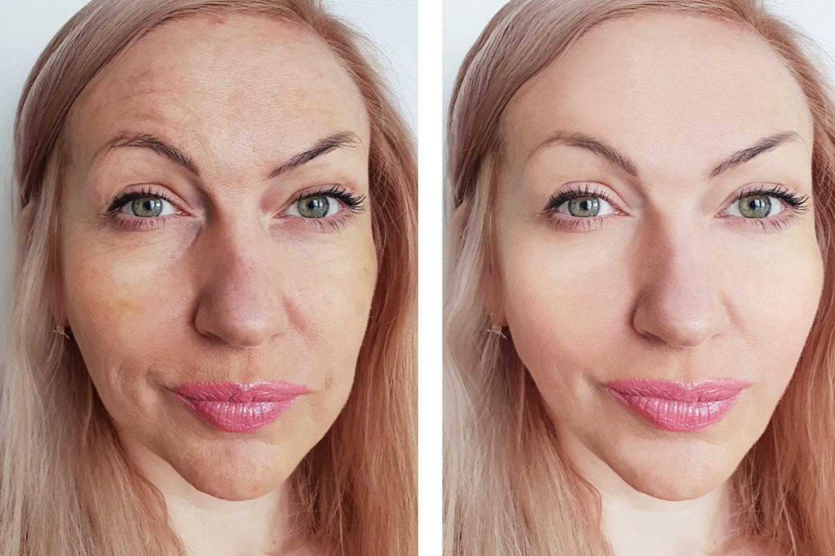 best makeup after laser resurfacing