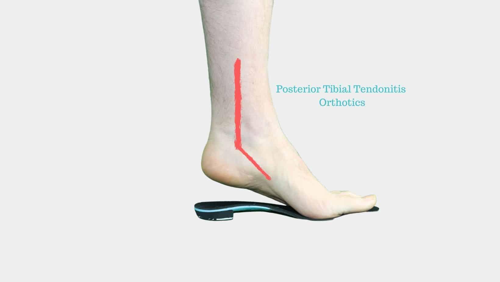 best over the counter orthotics for posterior tibial tendonitis