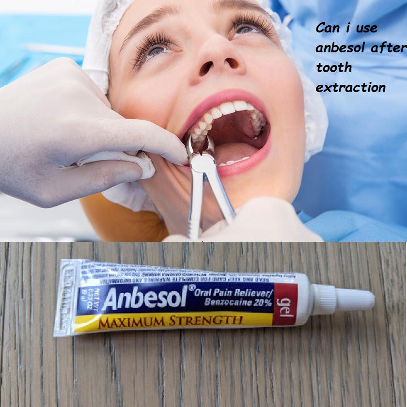 can i use anbesol after wisdom tooth extraction