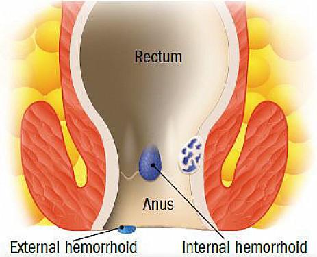 can i use clobetasol propionate for hemorrhoids