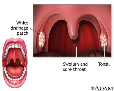 Strep throat