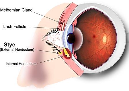 dermatologist or ophthalmologist for stye