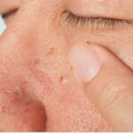 Skin Tags vs Cysts vs Warts: Identification Guide