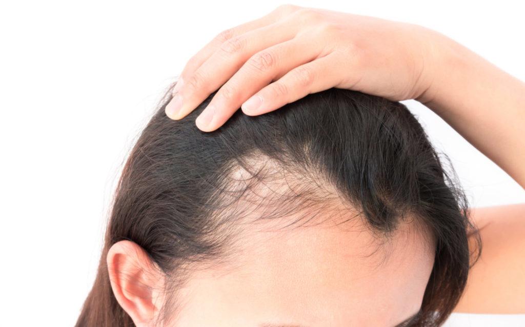 does parathyroid cause hair loss