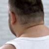 What Causes a Buffalo Hump on the Back of the Neck?