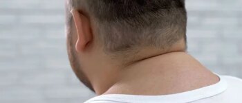 What Causes a Buffalo Hump on the Back of the Neck?