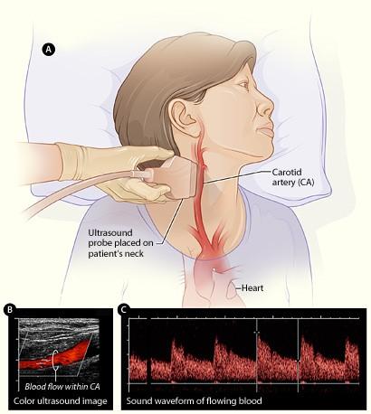 Ilustración de una mujer of a women recibiendo un ultrasonido del flujo de sangre en las arterias carótidas