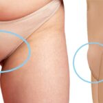 FUPA SURGERY, FAT UPPER PELVIC AREA LIPOSUCTION