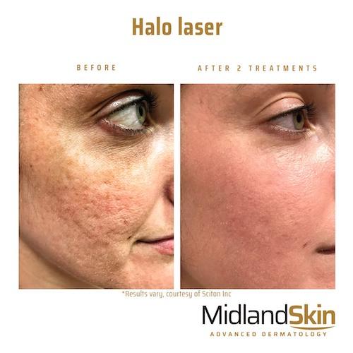 halo laser acne scars before and after