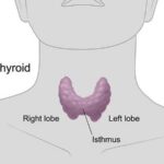 Genomic Test Helps Identify Thyroid Nodules That Don’t Require Surgery