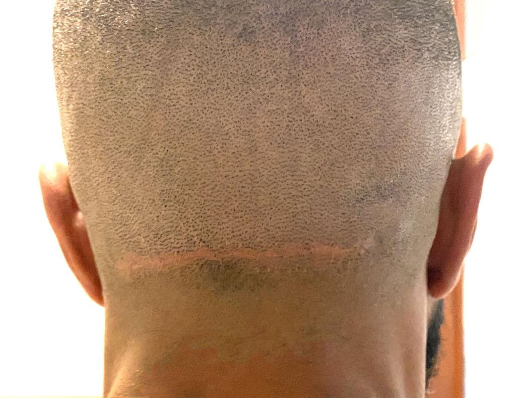 how to get rid of fat rolls on back of head