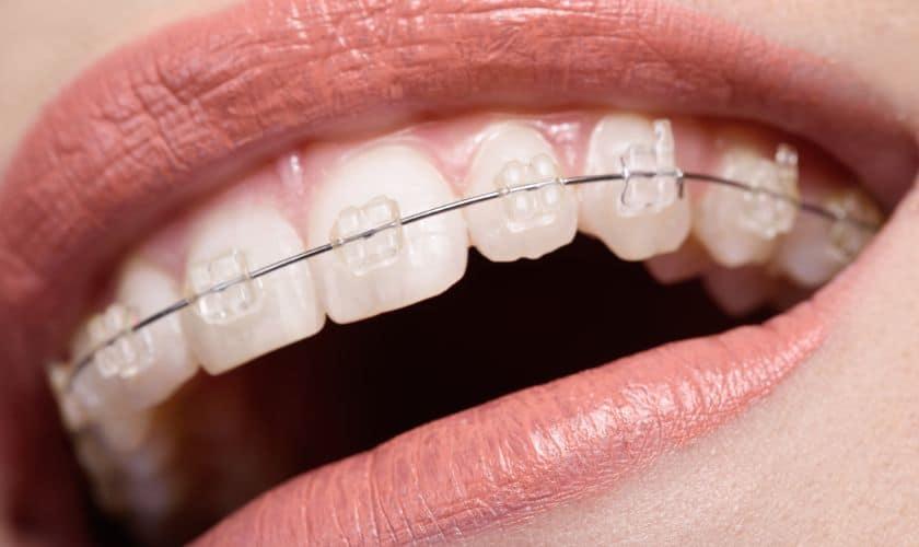 how to put braces wire back in