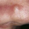 Fibrous Papule of the Nose: Symptoms, Complications, and Treatments