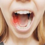 Signs You Have a Cavity Between Your Teeth