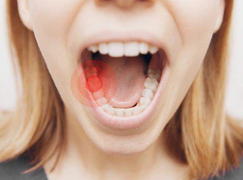 how to tell if you have a cavity between teeth