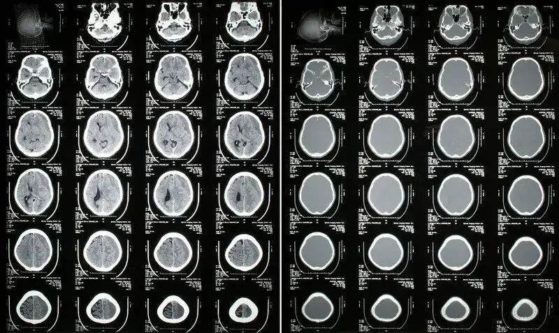 icd 10 code for chronic subdural hematoma