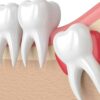 Go to an Emergency Dentistry to Deal With an Impacted Wisdom Tooth