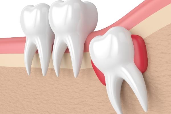 is an impacted wisdom tooth an emergency