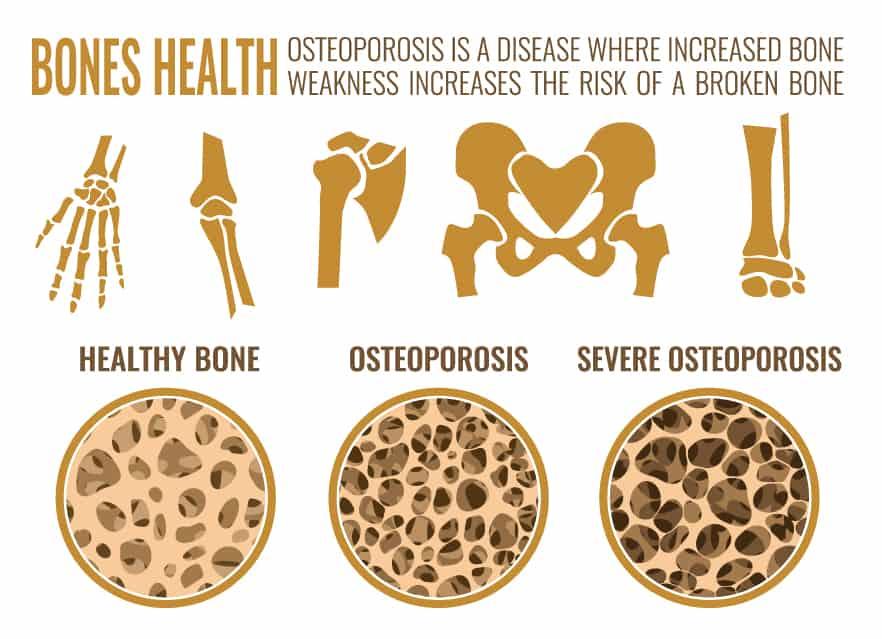 is chiropractic safe for osteoporosis