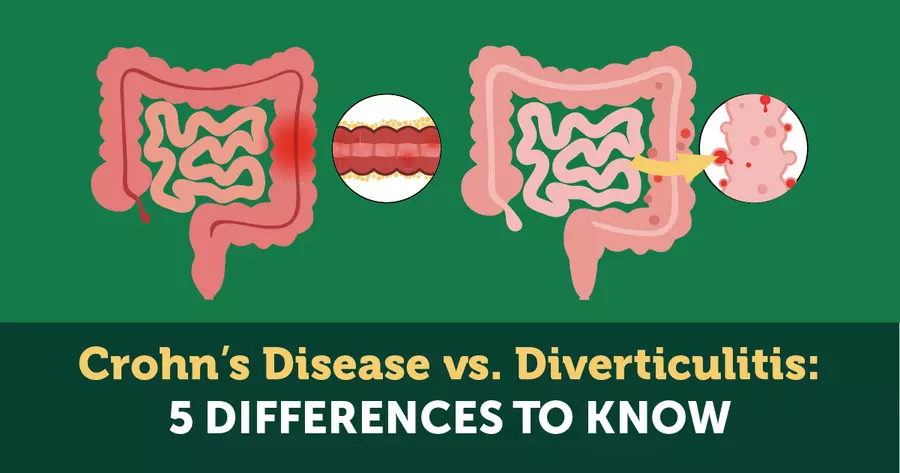 is diverticulitis the same as crohn's disease