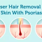 Is Laser Hair Removal Safe on Skin With Psoriasis?