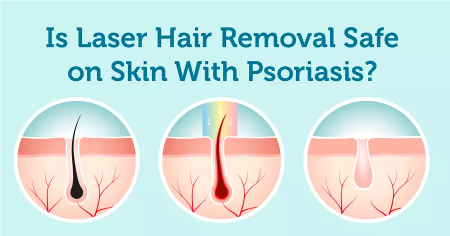 laser hair removal and psoriasis