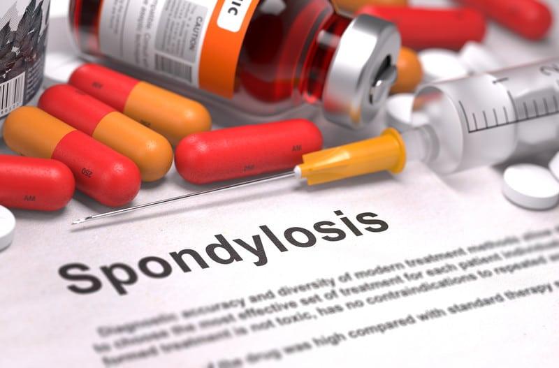 lumbosacral spondylosis with radiculopathy icd 10