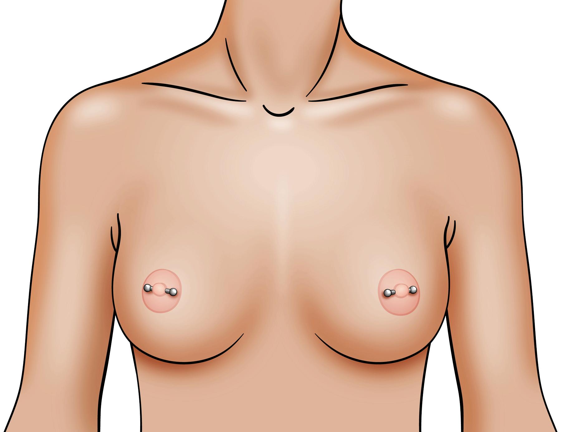 nipple piercing after breast reduction