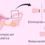 ¿Es reversible la ligadura de las trompas de Falopio?