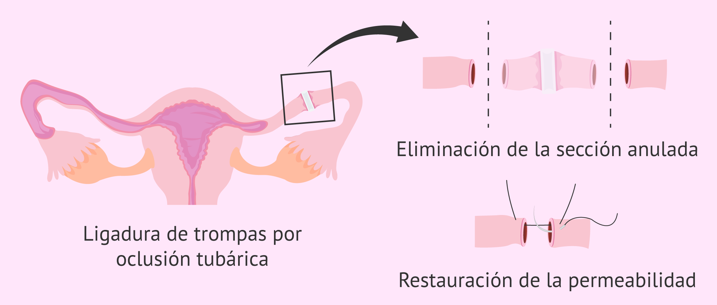 reversión de ligadura de trompas