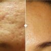 SkinPen Microneedling