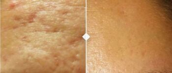 SkinPen Microneedling