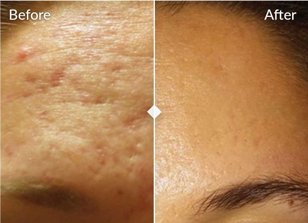 Before and after SkinPen microneedling treatment for acne scarring