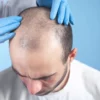 Will My Hair Grow Back After Mohs Surgery on Scalp?