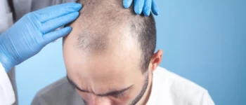 Will My Hair Grow Back After Mohs Surgery on Scalp?